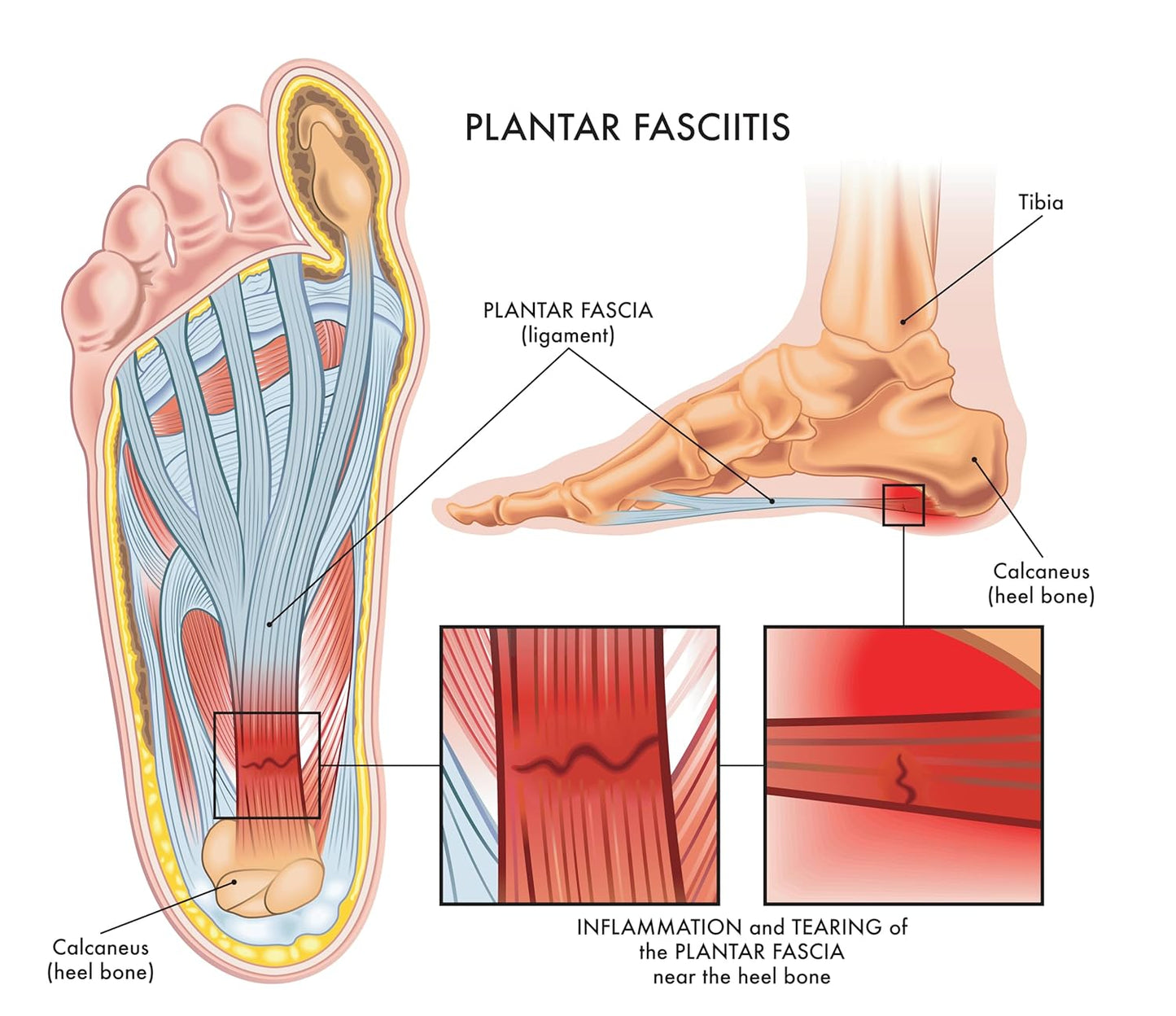 Plantar Fasciitis Relief - Heel Cups for Foot Pain Relief